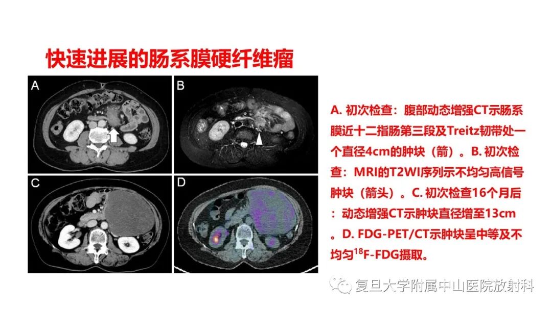 影像PPT - 【病例】肠系膜侵袭性纤维瘤病1例CT及MR影像-11