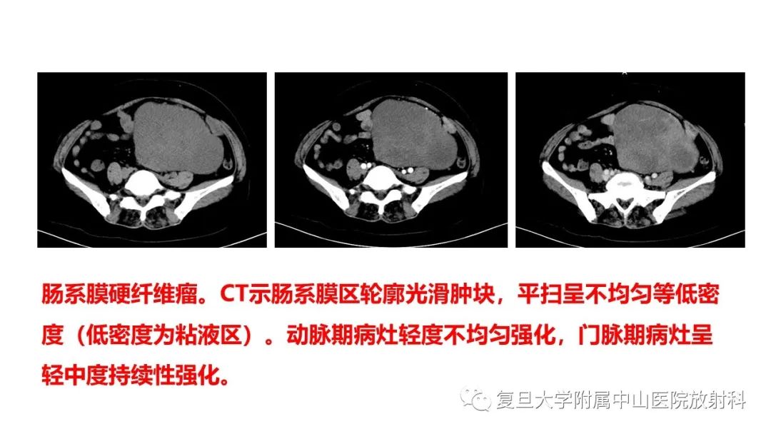 影像PPT - 【病例】肠系膜侵袭性纤维瘤病1例CT及MR影像-13