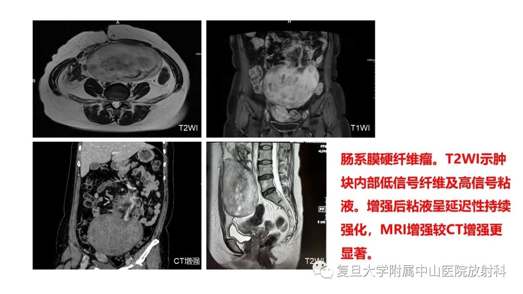 影像PPT - 【病例】肠系膜侵袭性纤维瘤病1例CT及MR影像-14