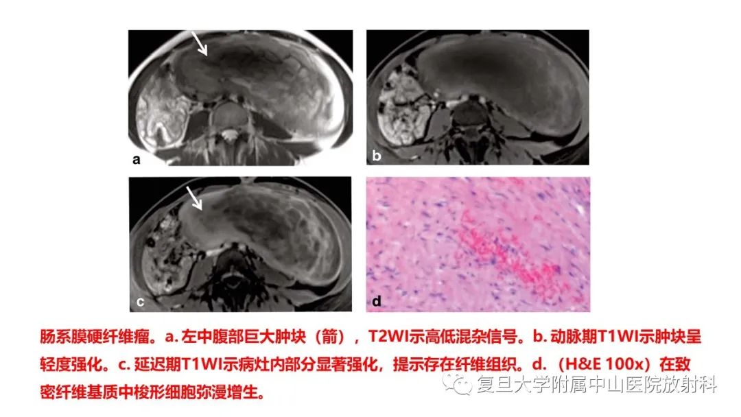影像PPT - 【病例】肠系膜侵袭性纤维瘤病1例CT及MR影像-15