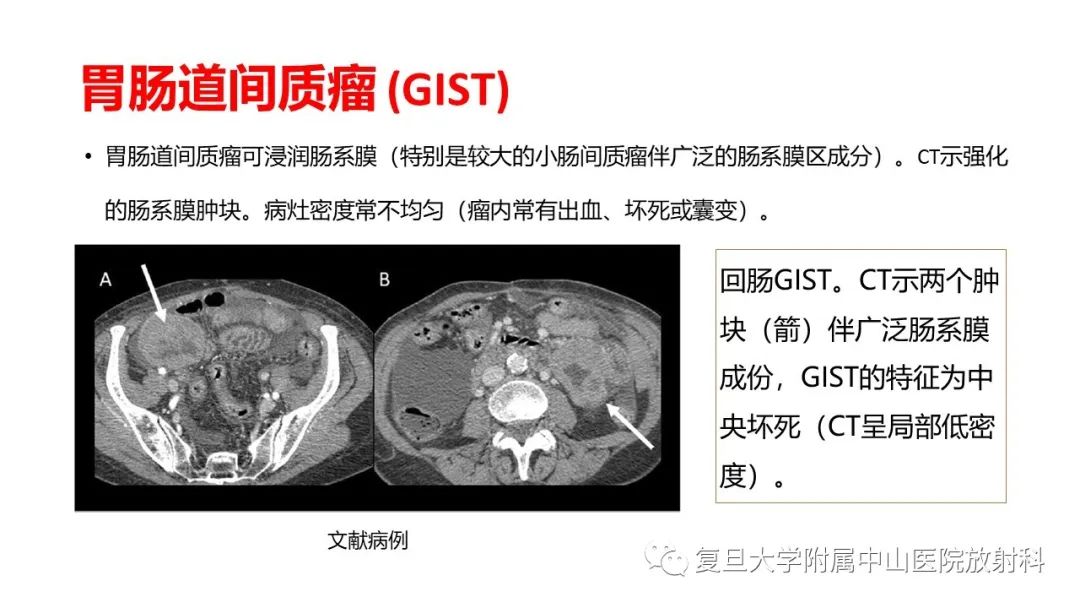 影像PPT - 【病例】肠系膜侵袭性纤维瘤病1例CT及MR影像-18
