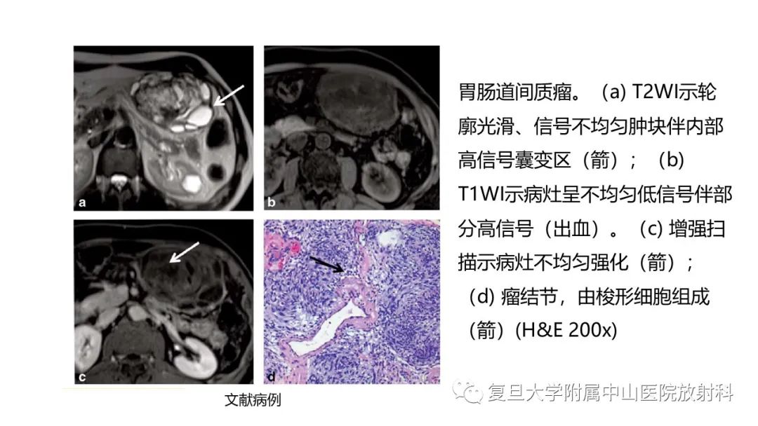 影像PPT - 【病例】肠系膜侵袭性纤维瘤病1例CT及MR影像-19