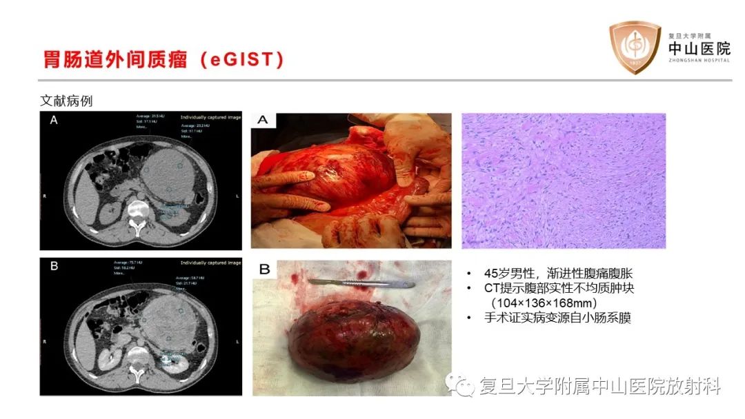影像PPT - 【病例】肠系膜侵袭性纤维瘤病1例CT及MR影像-20