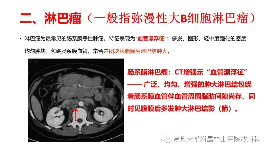 影像PPT - 【病例】肠系膜侵袭性纤维瘤病1例CT及MR影像-21