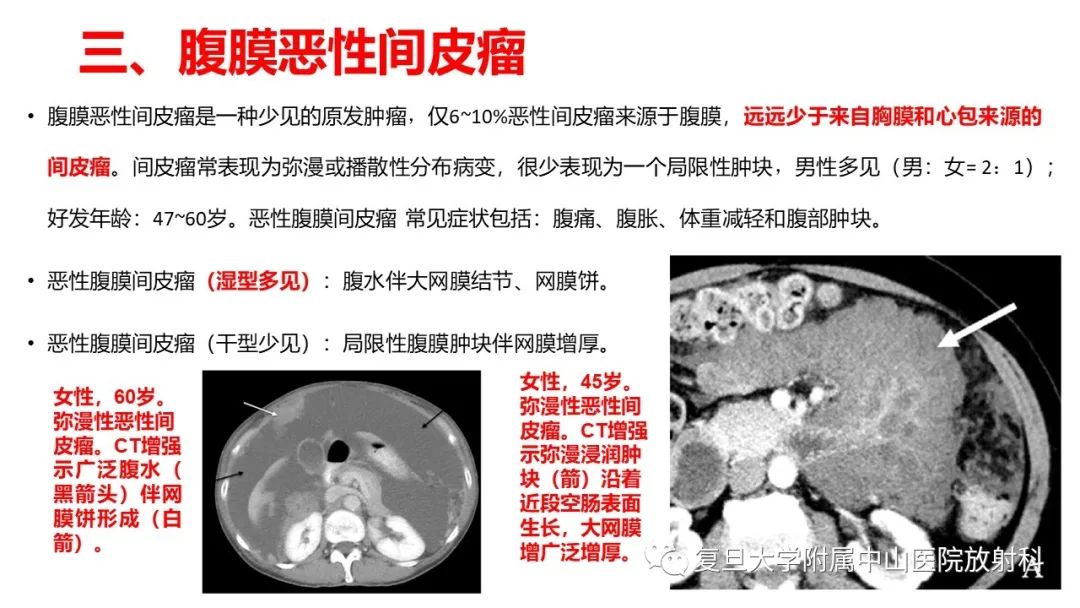 影像PPT - 【病例】肠系膜侵袭性纤维瘤病1例CT及MR影像-22