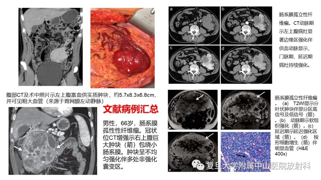 影像PPT - 【病例】肠系膜侵袭性纤维瘤病1例CT及MR影像-24