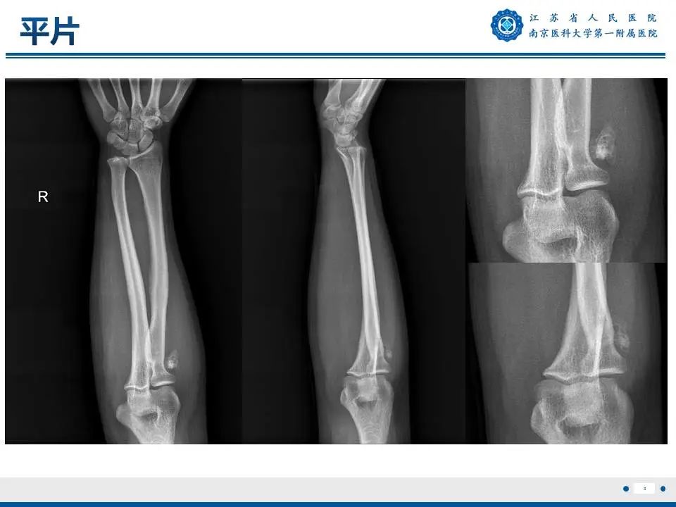 影像PPT - 【PPT】奇异性骨旁骨软骨瘤样增生-4