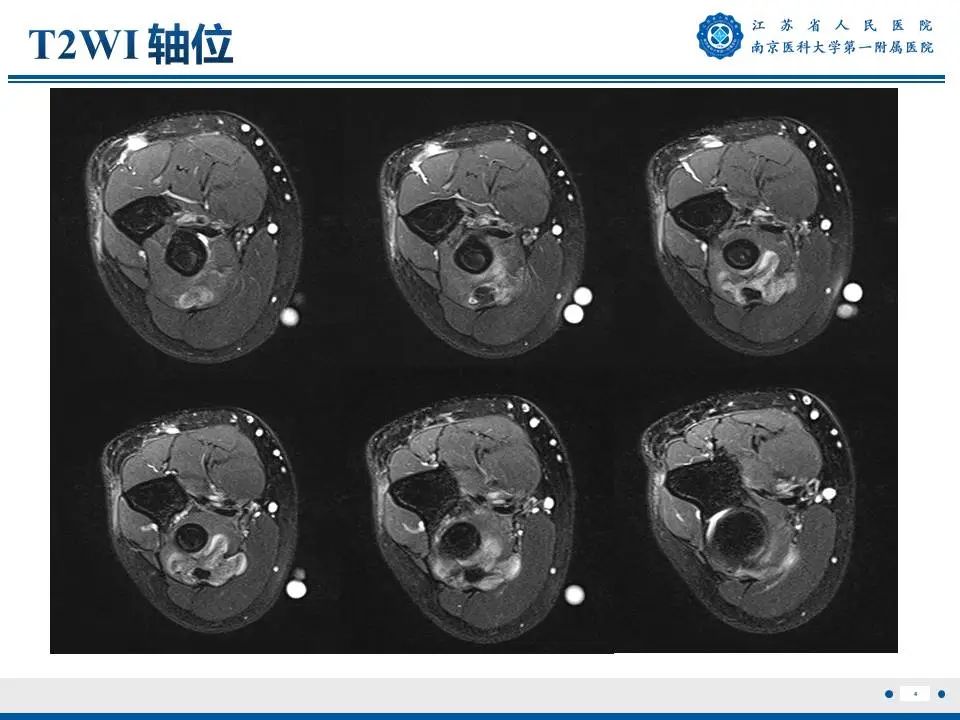 影像PPT - 【PPT】奇异性骨旁骨软骨瘤样增生-5