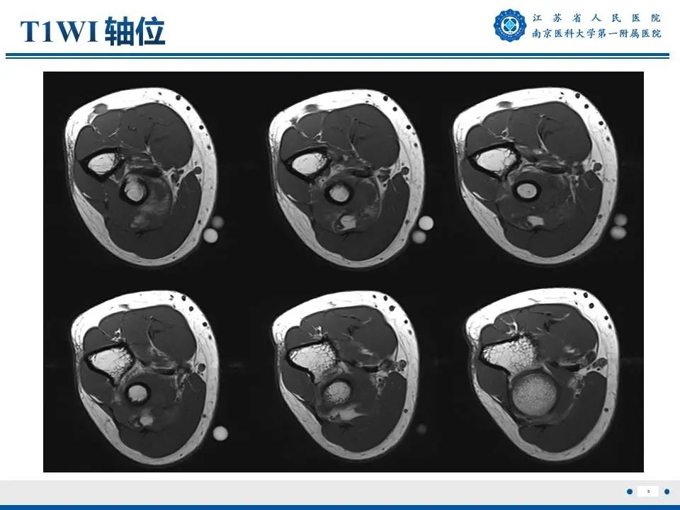 影像PPT - 【PPT】奇异性骨旁骨软骨瘤样增生-6