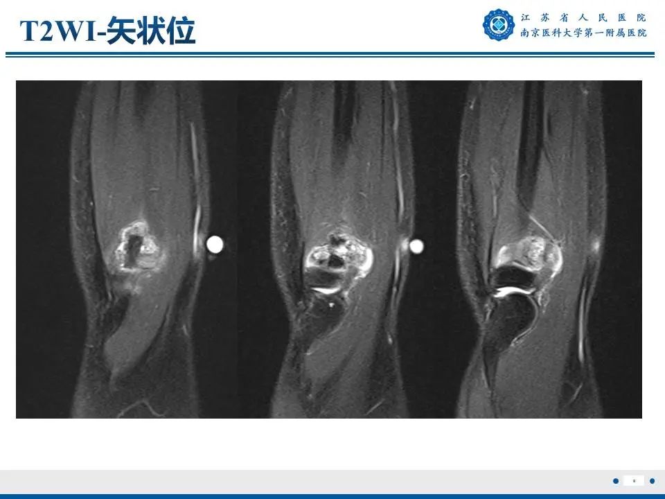 影像PPT - 【PPT】奇异性骨旁骨软骨瘤样增生-9