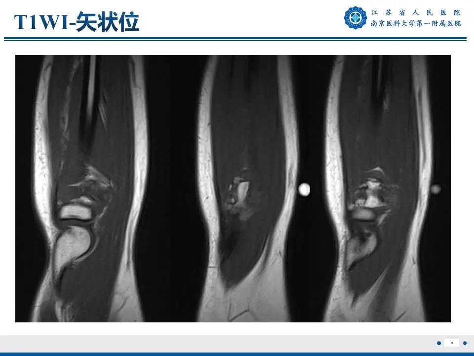 影像PPT - 【PPT】奇异性骨旁骨软骨瘤样增生-10