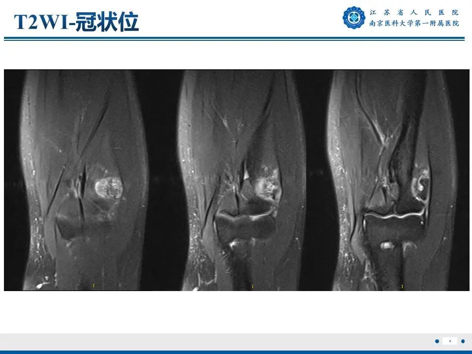 影像PPT - 【PPT】奇异性骨旁骨软骨瘤样增生-7