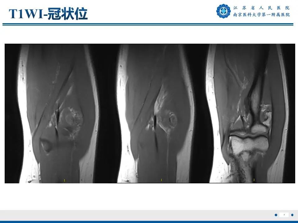 影像PPT - 【PPT】奇异性骨旁骨软骨瘤样增生-8