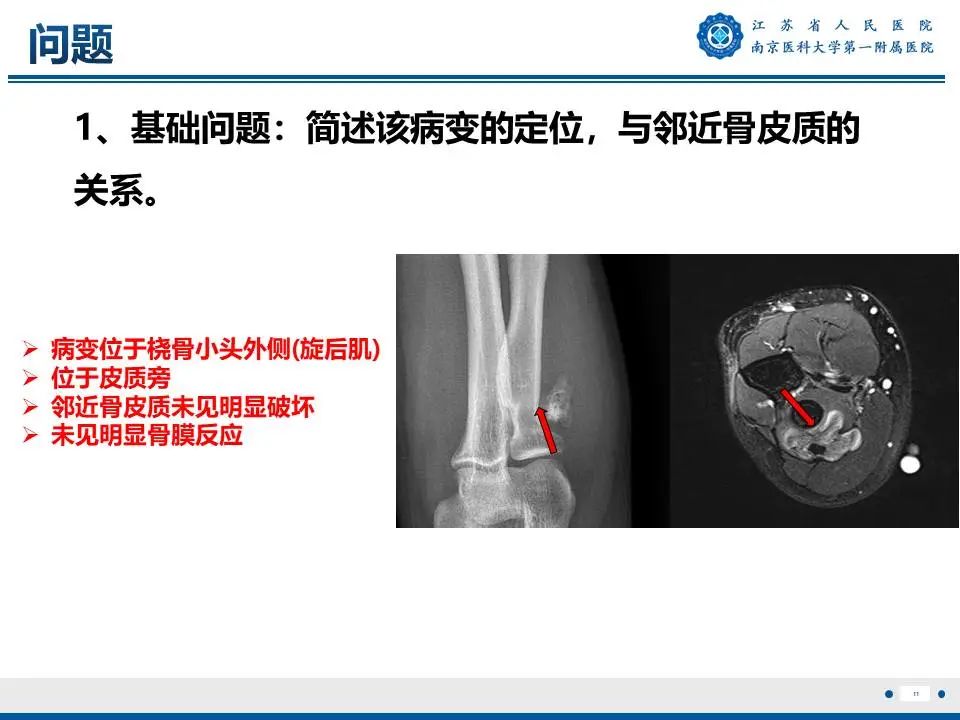 影像PPT - 【PPT】奇异性骨旁骨软骨瘤样增生-12