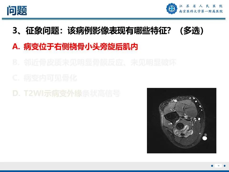 影像PPT - 【PPT】奇异性骨旁骨软骨瘤样增生-17