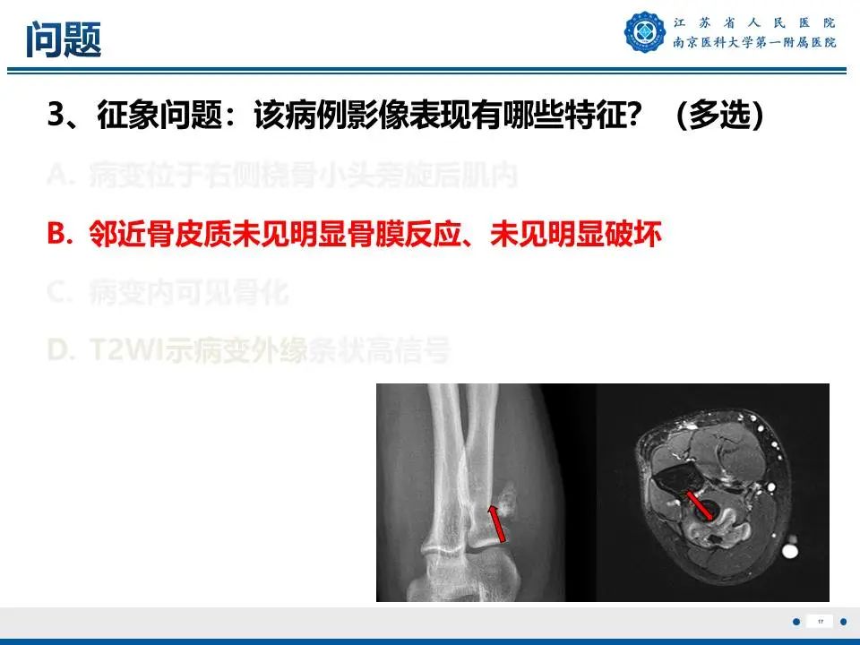 影像PPT - 【PPT】奇异性骨旁骨软骨瘤样增生-18