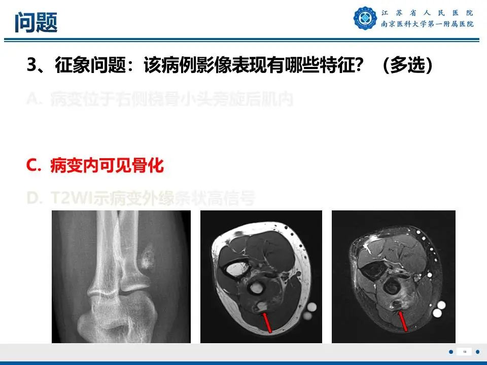 影像PPT - 【PPT】奇异性骨旁骨软骨瘤样增生-19