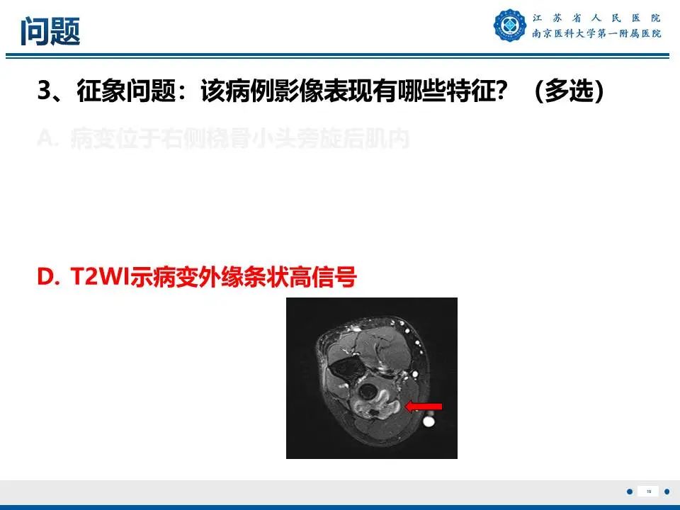 影像PPT - 【PPT】奇异性骨旁骨软骨瘤样增生-20