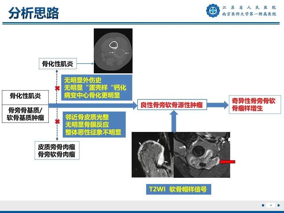 影像PPT - 【PPT】奇异性骨旁骨软骨瘤样增生-23