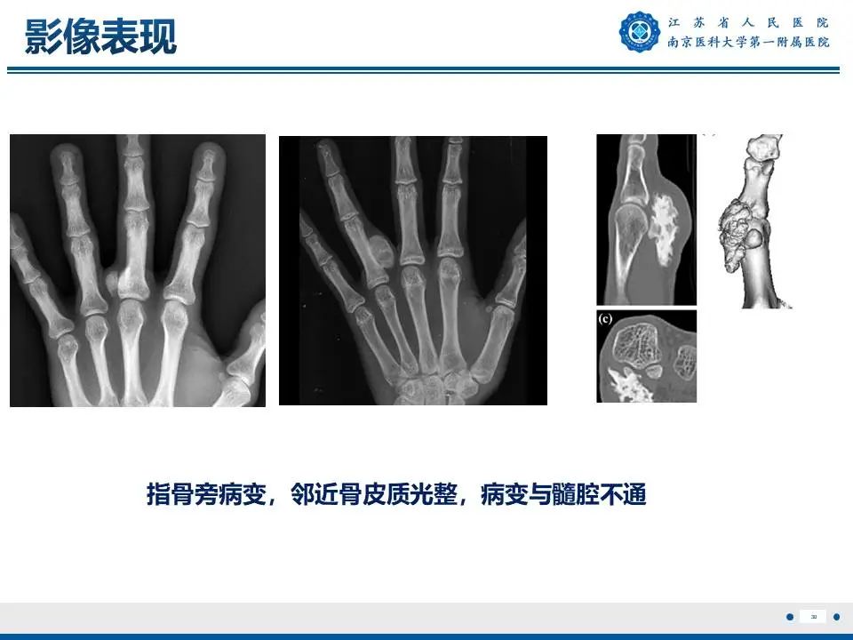 影像PPT - 【PPT】奇异性骨旁骨软骨瘤样增生-31