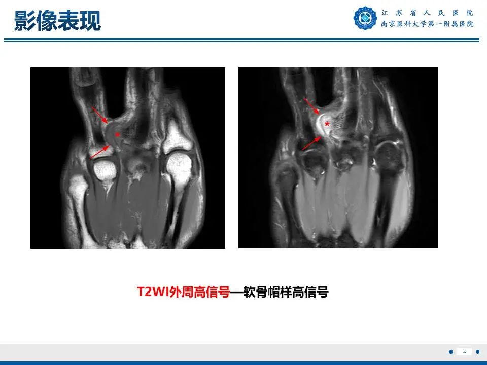 影像PPT - 【PPT】奇异性骨旁骨软骨瘤样增生-33