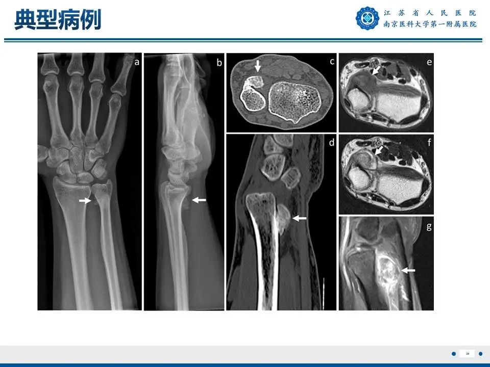 影像PPT - 【PPT】奇异性骨旁骨软骨瘤样增生-35