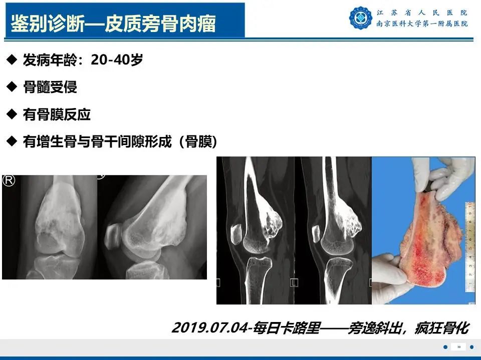 影像PPT - 【PPT】奇异性骨旁骨软骨瘤样增生-40
