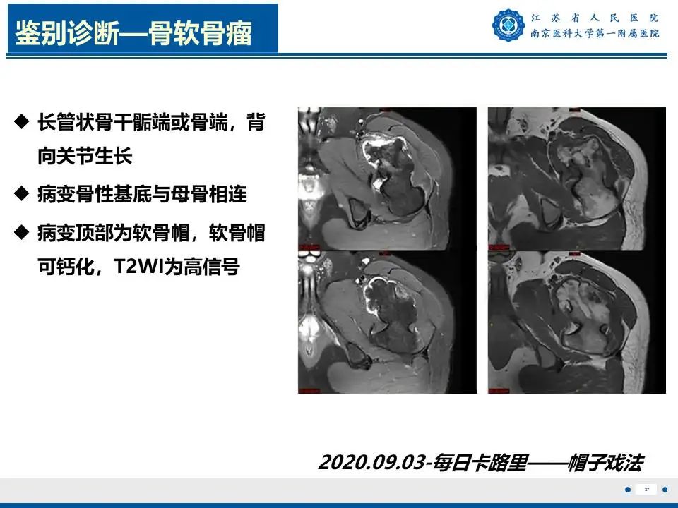 影像PPT - 【PPT】奇异性骨旁骨软骨瘤样增生-38