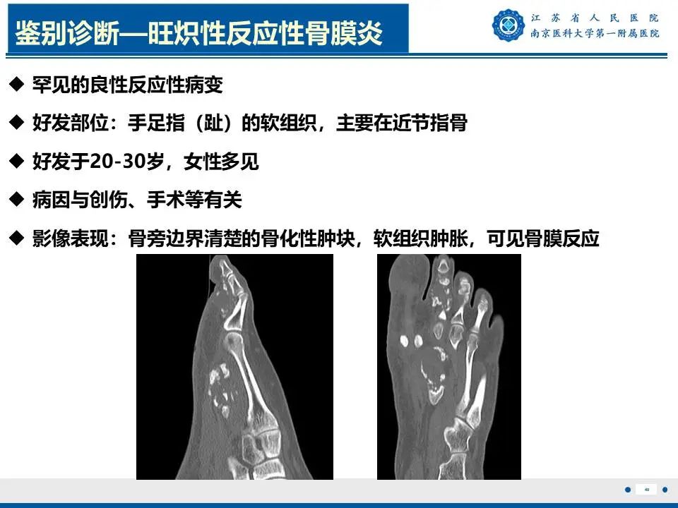 影像PPT - 【PPT】奇异性骨旁骨软骨瘤样增生-41