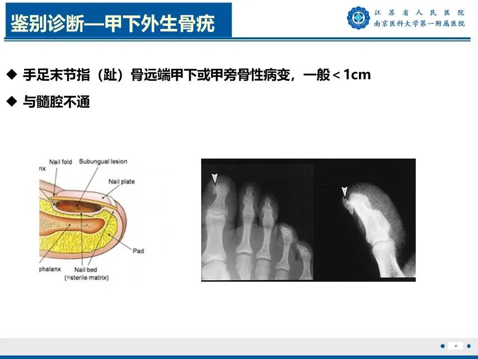 影像PPT - 【PPT】奇异性骨旁骨软骨瘤样增生-42