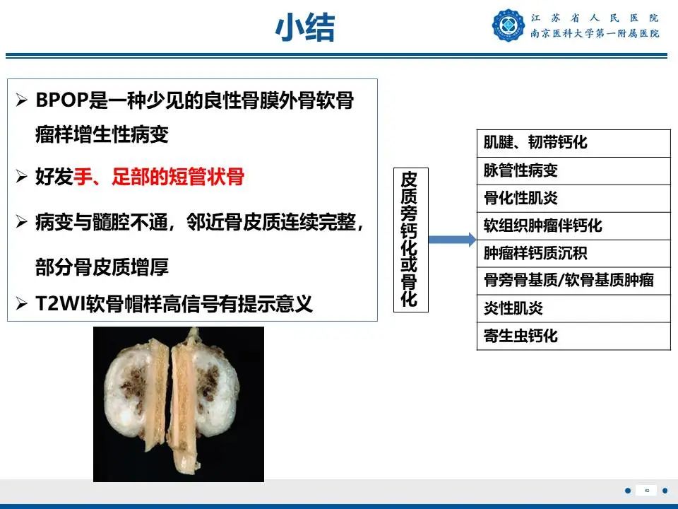 影像PPT - 【PPT】奇异性骨旁骨软骨瘤样增生-43