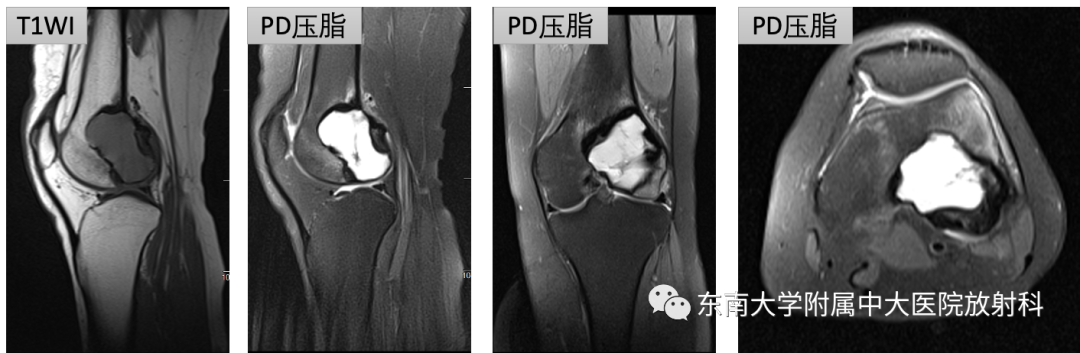 影像PPT - 【PPT】骨巨细胞瘤-1 影像PPT - 【PPT】骨巨细胞瘤-1