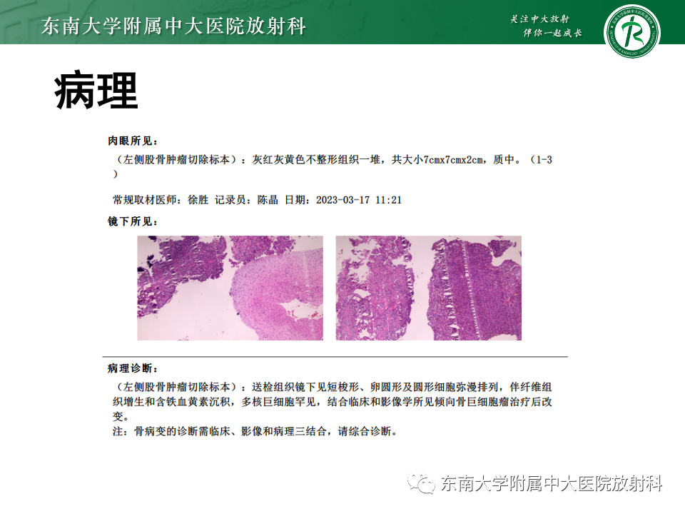 影像PPT - 【PPT】骨巨细胞瘤-3 影像PPT - 【PPT】骨巨细胞瘤-3