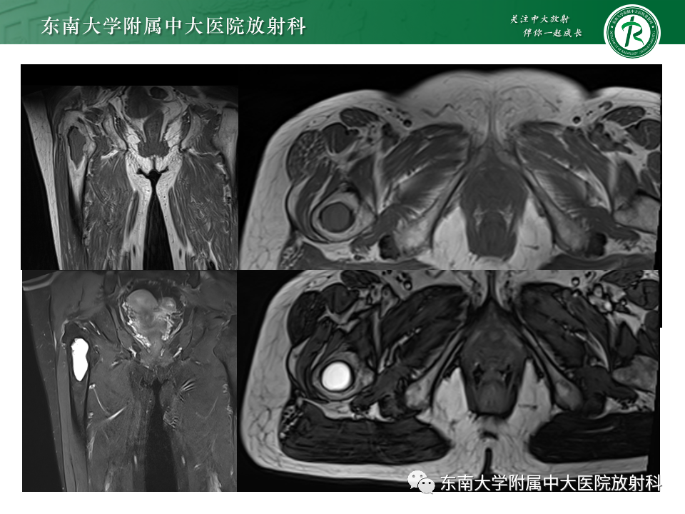 影像PPT - 【PPT】骨巨细胞瘤-16 影像PPT - 【PPT】骨巨细胞瘤-16