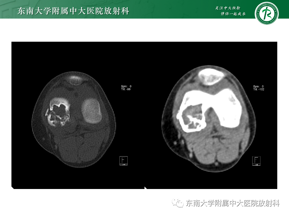 影像PPT - 【PPT】骨巨细胞瘤-19 影像PPT - 【PPT】骨巨细胞瘤-19