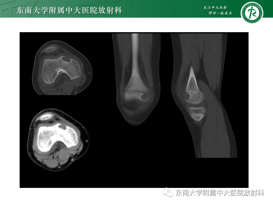影像PPT - 【PPT】骨巨细胞瘤-21 影像PPT - 【PPT】骨巨细胞瘤-21
