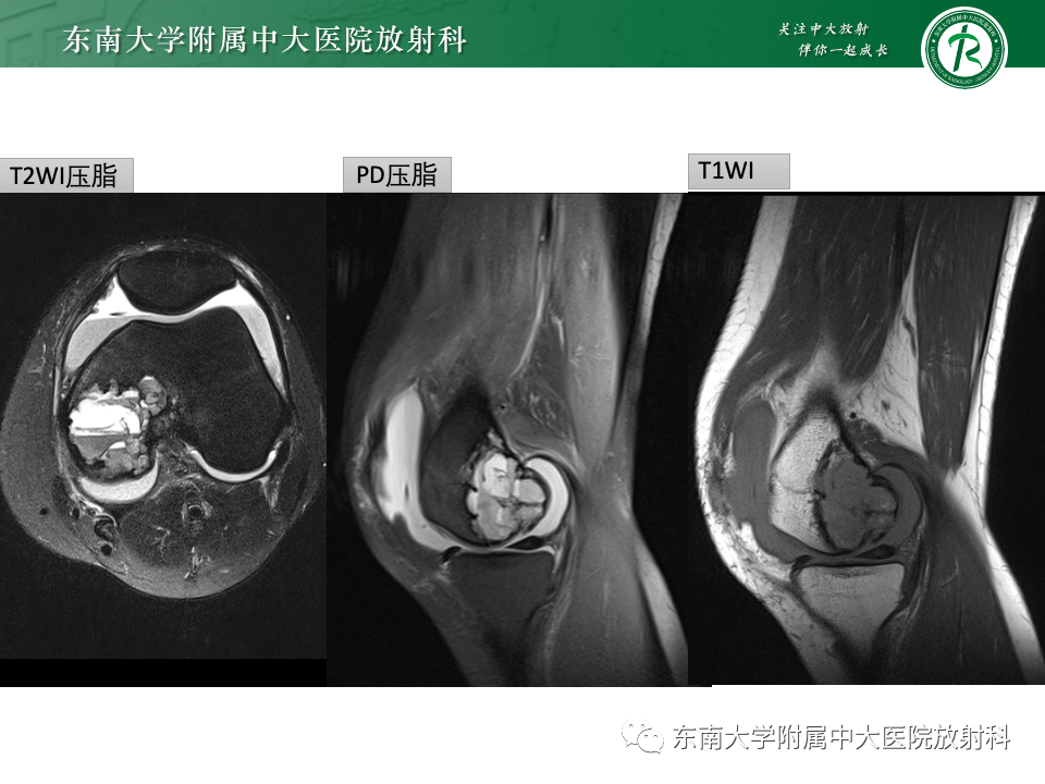 影像PPT - 【PPT】骨巨细胞瘤-18 影像PPT - 【PPT】骨巨细胞瘤-18