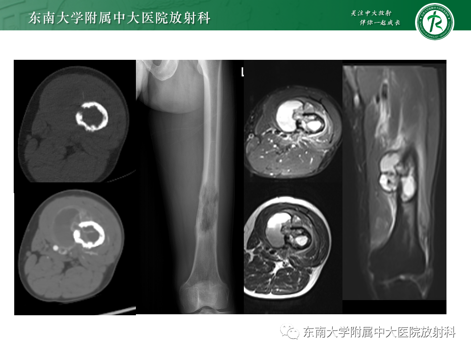 影像PPT - 【PPT】骨巨细胞瘤-23 影像PPT - 【PPT】骨巨细胞瘤-23
