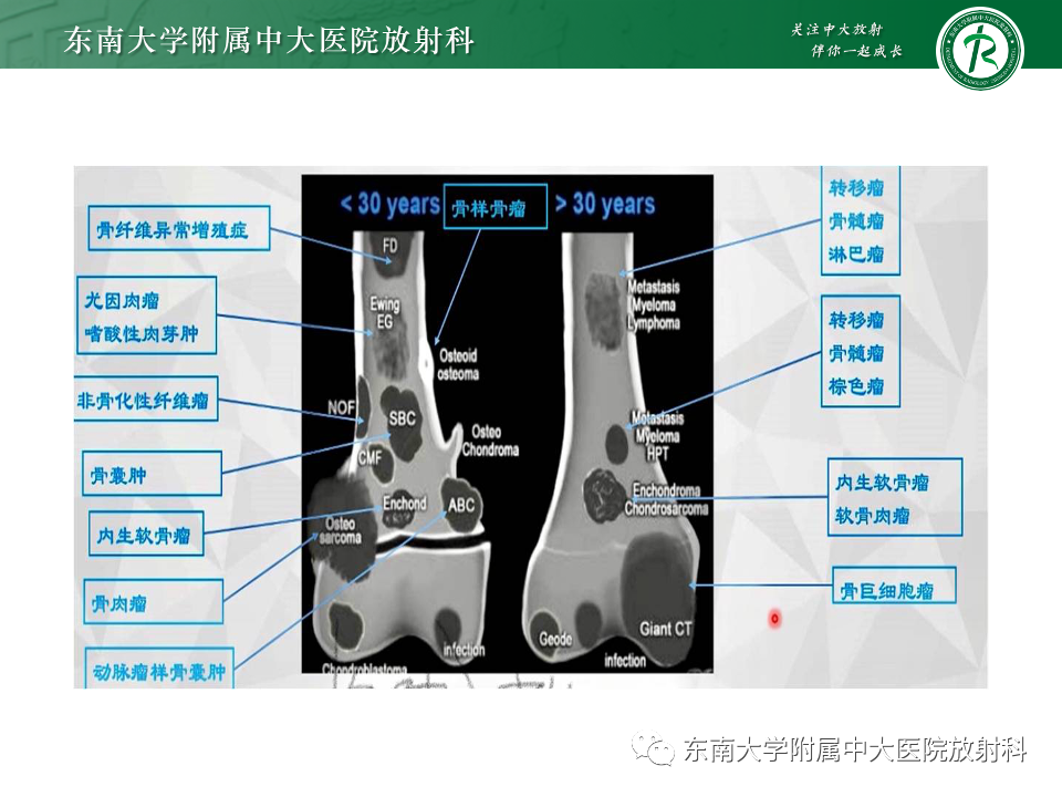 影像PPT - 【PPT】骨巨细胞瘤-25 影像PPT - 【PPT】骨巨细胞瘤-25