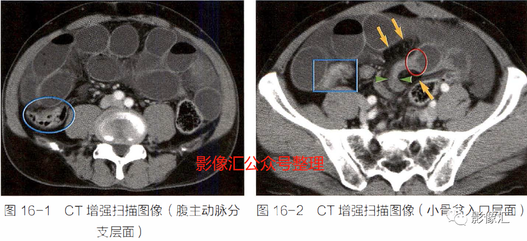 影像PPT - 肠梗阻影像诊断技巧及要点-1 影像PPT - 肠梗阻影像诊断技巧及要点-1