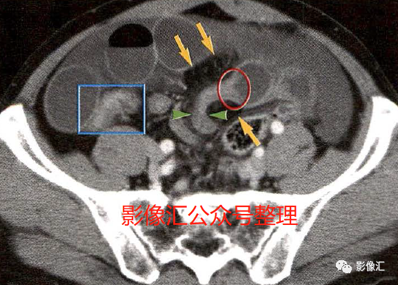 影像PPT - 肠梗阻影像诊断技巧及要点-4 影像PPT - 肠梗阻影像诊断技巧及要点-4