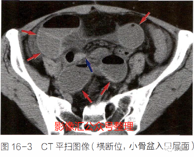 影像PPT - 肠梗阻影像诊断技巧及要点-6 影像PPT - 肠梗阻影像诊断技巧及要点-6