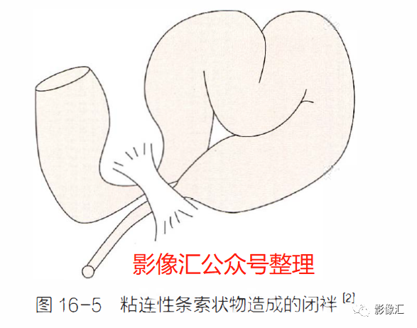 影像PPT - 肠梗阻影像诊断技巧及要点-8 影像PPT - 肠梗阻影像诊断技巧及要点-8
