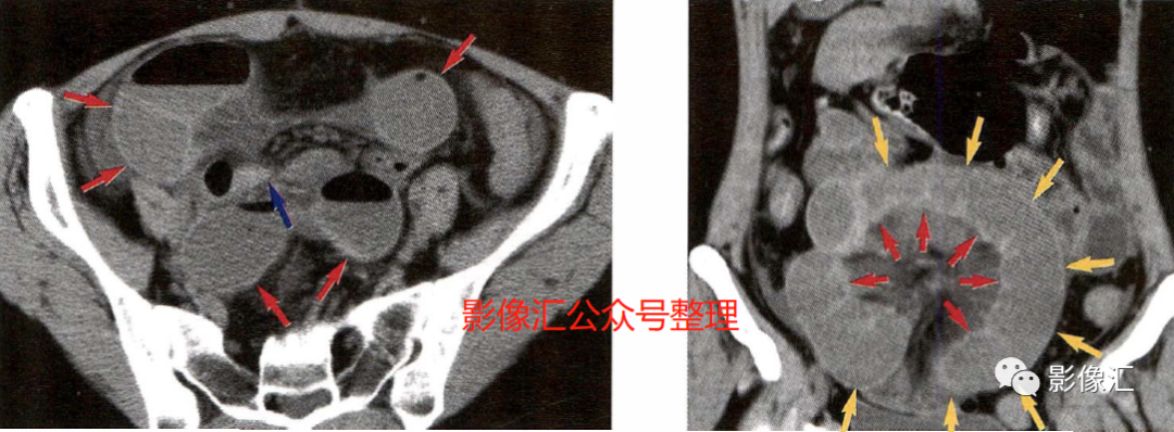 影像PPT - 肠梗阻影像诊断技巧及要点-9 影像PPT - 肠梗阻影像诊断技巧及要点-9