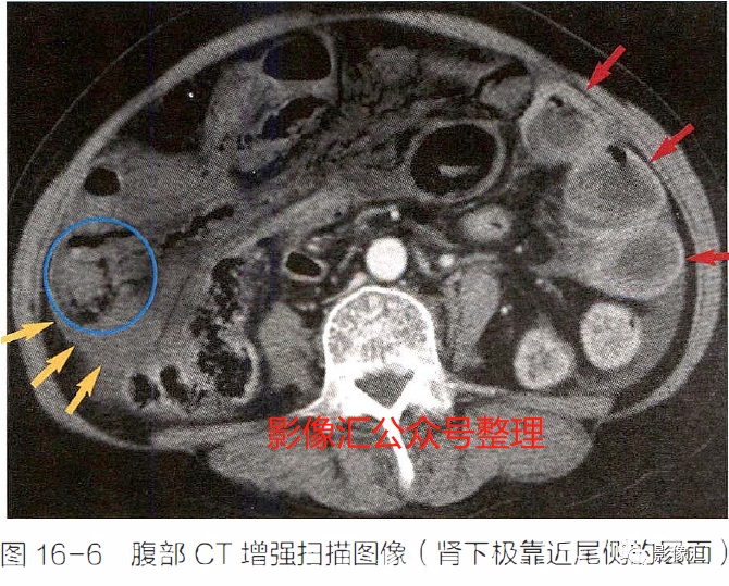 影像PPT - 肠梗阻影像诊断技巧及要点-10 影像PPT - 肠梗阻影像诊断技巧及要点-10