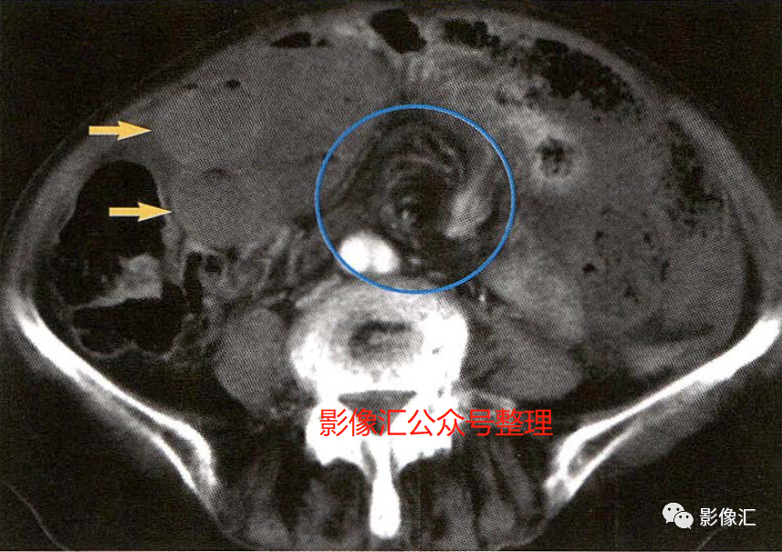 影像PPT - 肠梗阻影像诊断技巧及要点-11 影像PPT - 肠梗阻影像诊断技巧及要点-11