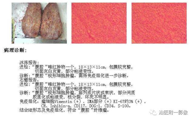 影像PPT - 【病例】腹盆腔孤立性纤维瘤2例CT影像-6