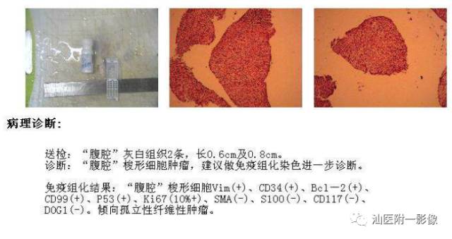 影像PPT - 【病例】腹盆腔孤立性纤维瘤2例CT影像-8