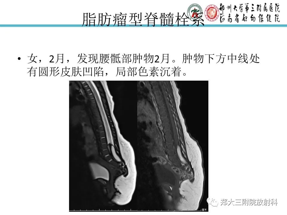 影像PPT - 【PPT】脊髓栓系综合征-16