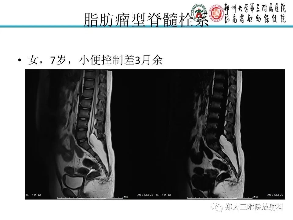 影像PPT - 【PPT】脊髓栓系综合征-17